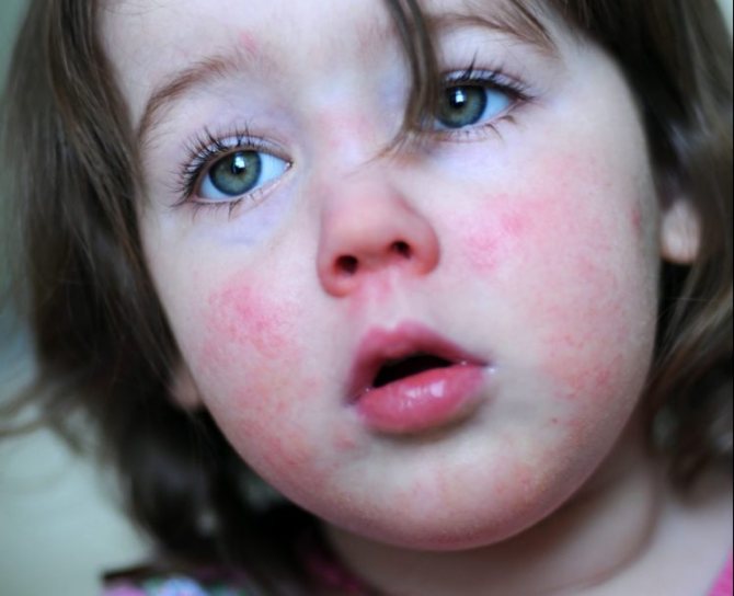 Пищевая аллергия у детей: диагностика